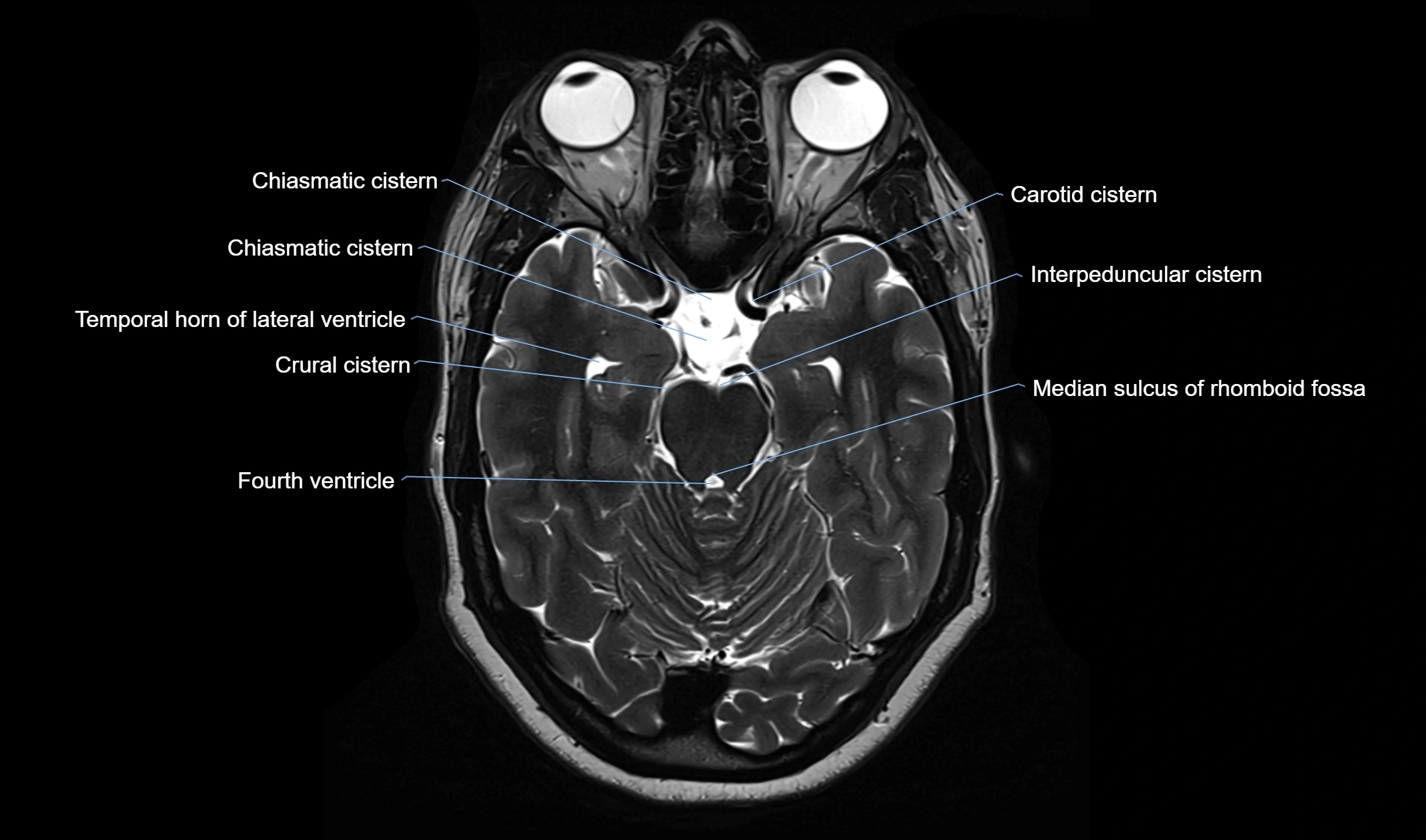 Brain cisterns  and ventricles  axial anatomy 3T MRI image-img-00001-00019.webp